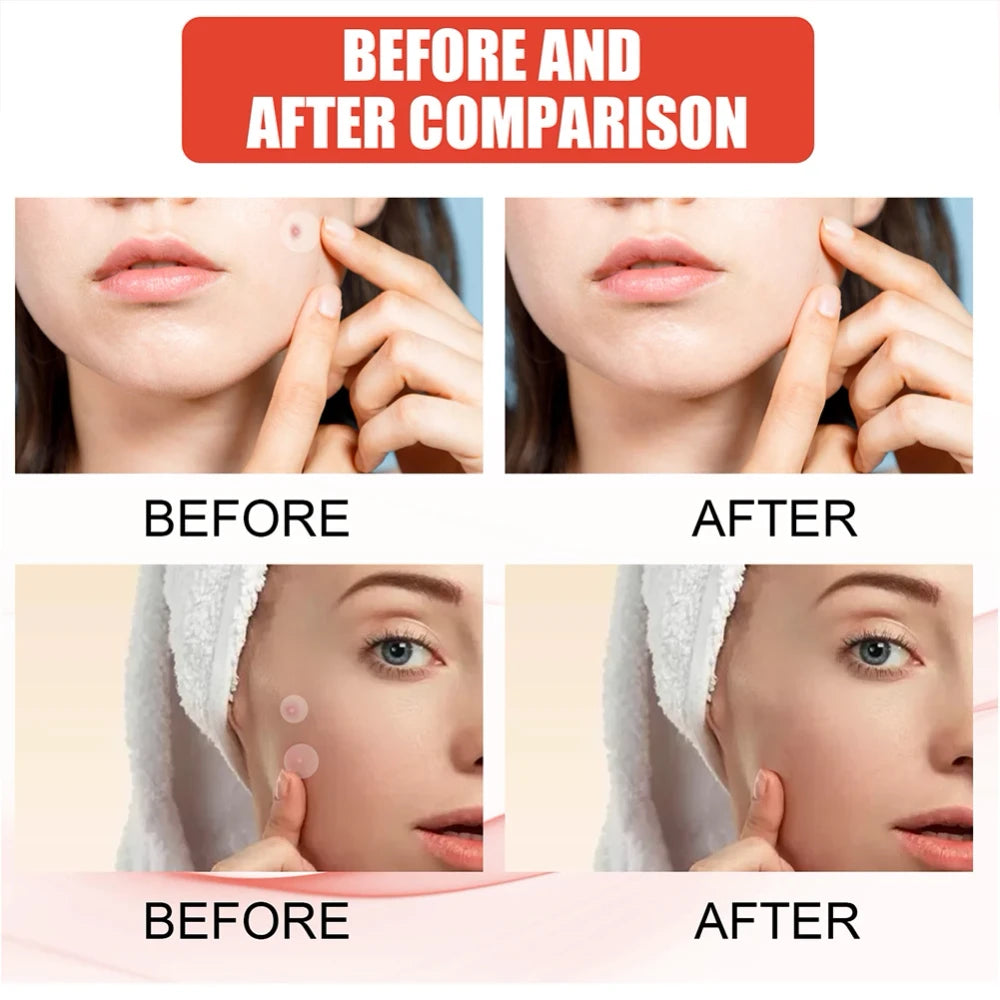 Hydrocolloid Acne Pimple Patch for Overnight Healing